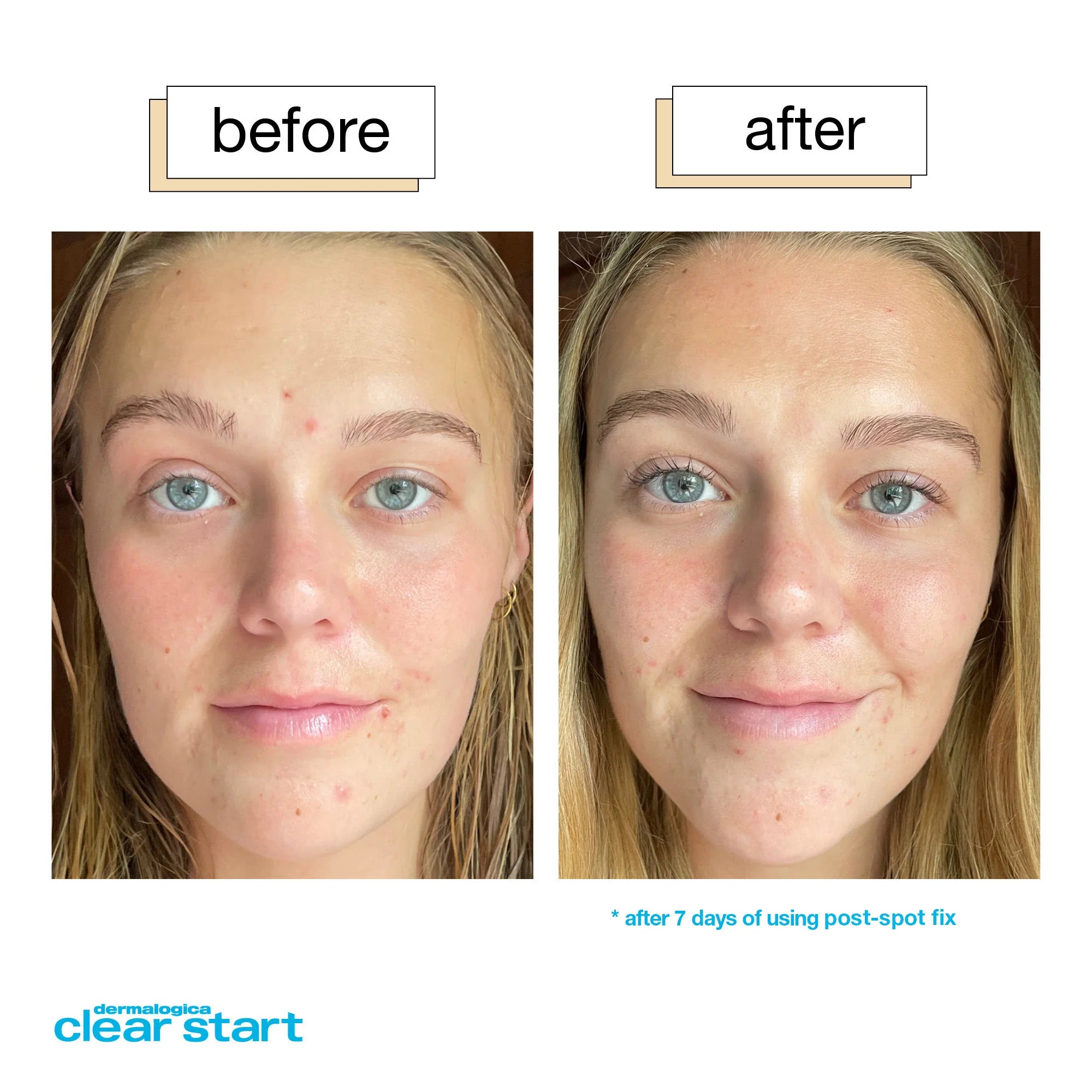 Dermalogica® Post-Spot Fix